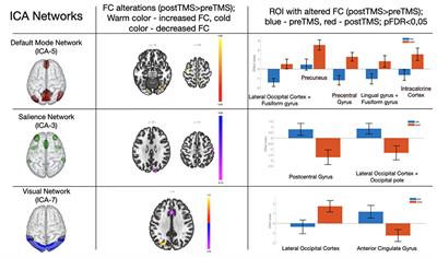 fMRI Findings in Cortical Brain Networks Interactions in Migraine Following Repetitive Transcranial Magnetic Stimulation